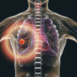 Lung Cancer Stigma