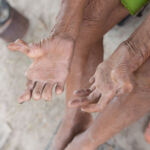 Leprosy