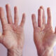 Dupuytren Disease and Disabled Hands