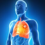 Lung Cancer, No Smoking